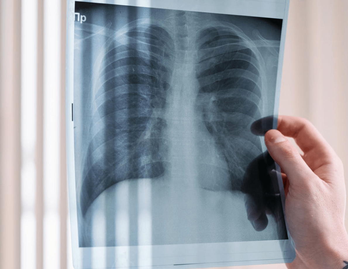 radiografia pulmones